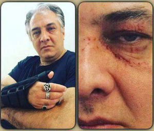 صورت زخمی ایرج نوذری و دست اسیب دیده ی وی طی یک حادثه
